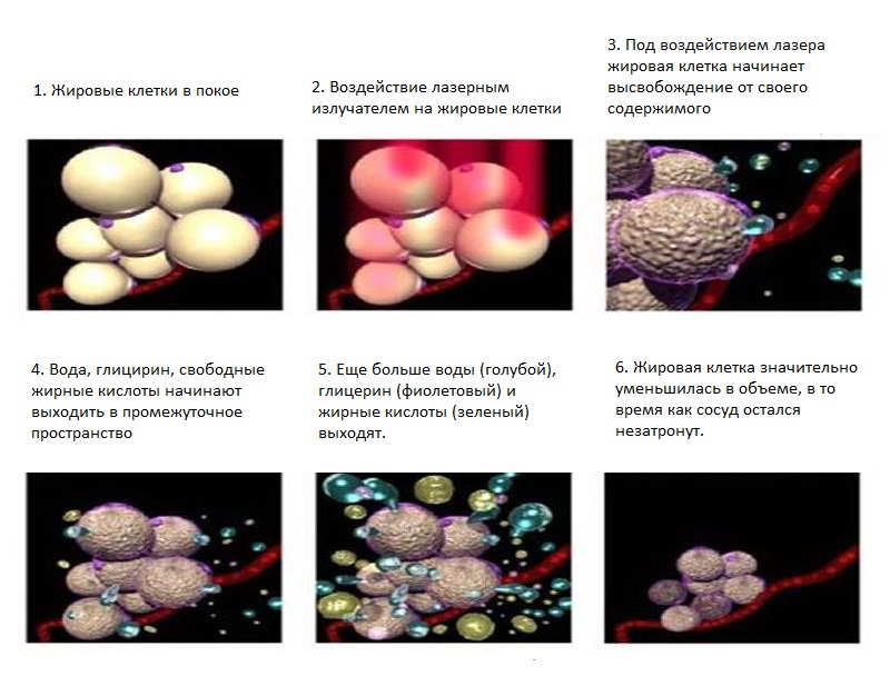 Процесс удаления целлюлита лазером